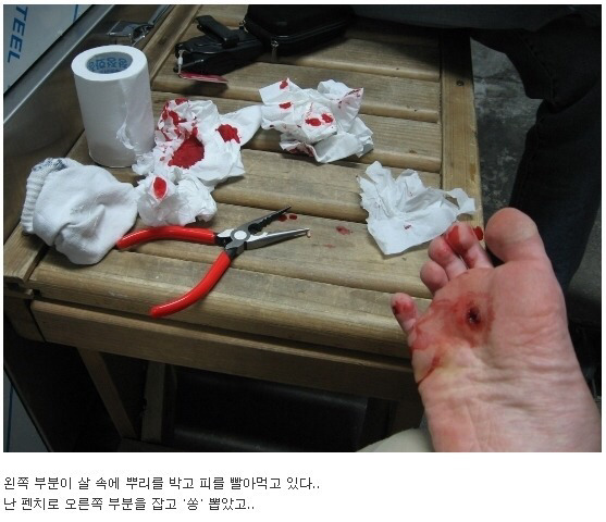 이쯤에서 생각나는 티눈뽑기 (혐오주의) | 인스티즈