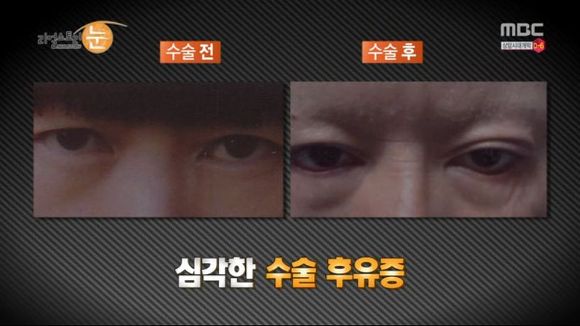 [리얼스토리눈] 15곳을 수술한 여자 내 얼굴을 찾아주세요 (성형수술 부작용) | 인스티즈