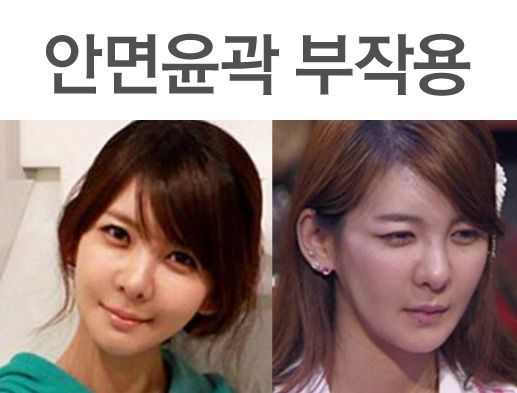 성형외과 종사자들이 말하는 부작용 위험높은 수술 쓰리톱 (혐오주의) | 인스티즈