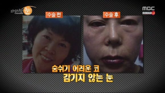 [리얼스토리눈] 15곳을 수술한 여자 내 얼굴을 찾아주세요 (성형수술 부작용) | 인스티즈