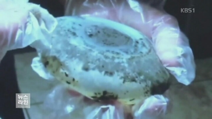 성형외과 종사자들이 말하는 부작용 위험높은 수술 쓰리톱 (혐오주의) | 인스티즈