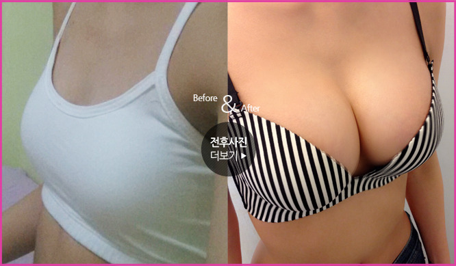 성형외과 종사자들이 말하는 부작용 위험높은 수술 쓰리톱 (혐오주의) | 인스티즈