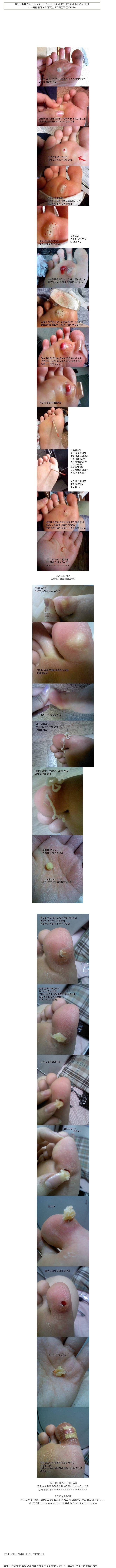 어떤 여성의 생생한 티눈일기 (시룸오주의) | 인스티즈