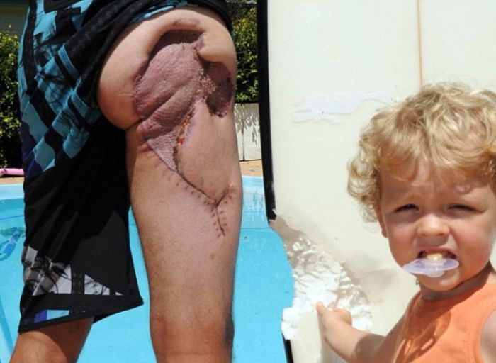 상어한테 물렸다 살아난 남자 | 인스티즈