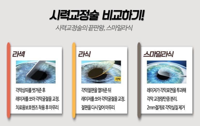 라섹 vs 라식 vs 스마일라식 비교 .jpg | 인스티즈