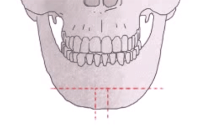 턱수술과 양악수술의 차이.gif | 인스티즈