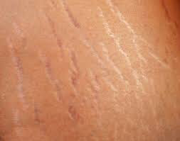 가격 대비 치료 효과 미미한 피부 고민 삼대장 (혐오주의) | 인스티즈