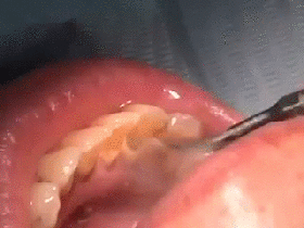 치석제거 GIF | 인스티즈