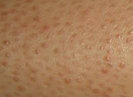 가격 대비 치료 효과 미미한 피부 고민 삼대장 (혐오주의) | 인스티즈