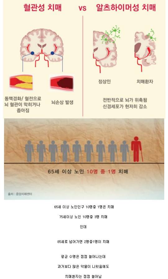 치매가 무서운 이유 | 인스티즈