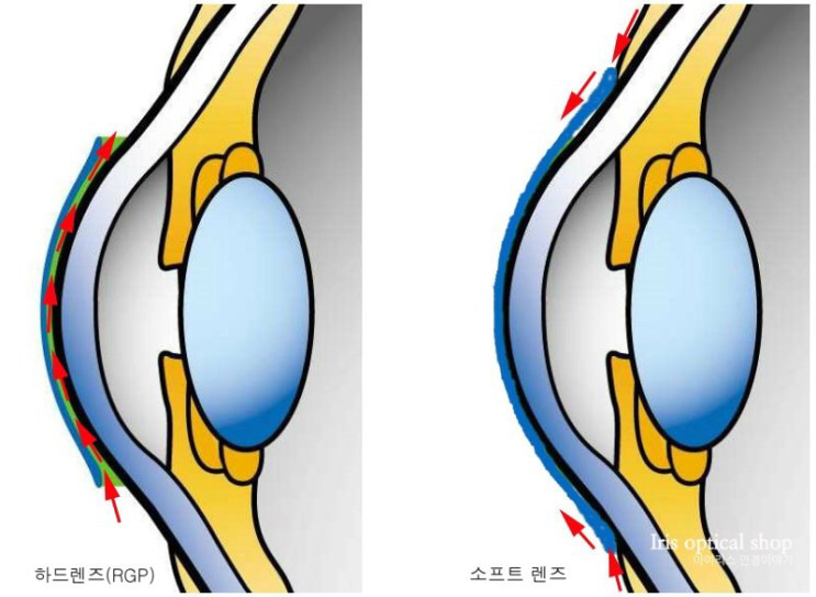 소프트렌즈 vs 하드렌즈.jpg | 인스티즈