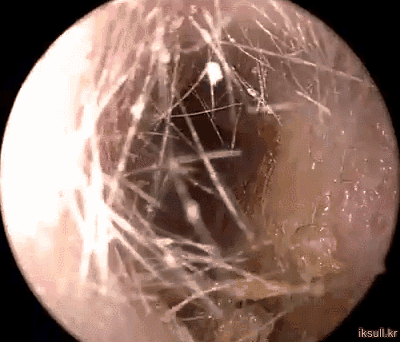 귀지 제거.gif | 인스티즈