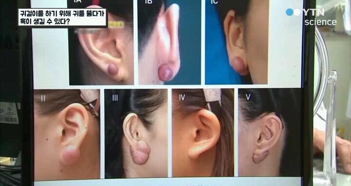 귀걸이하려다 수술까지.jpg (사진주의) | 인스티즈