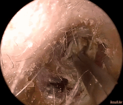 귀지 제거.gif | 인스티즈