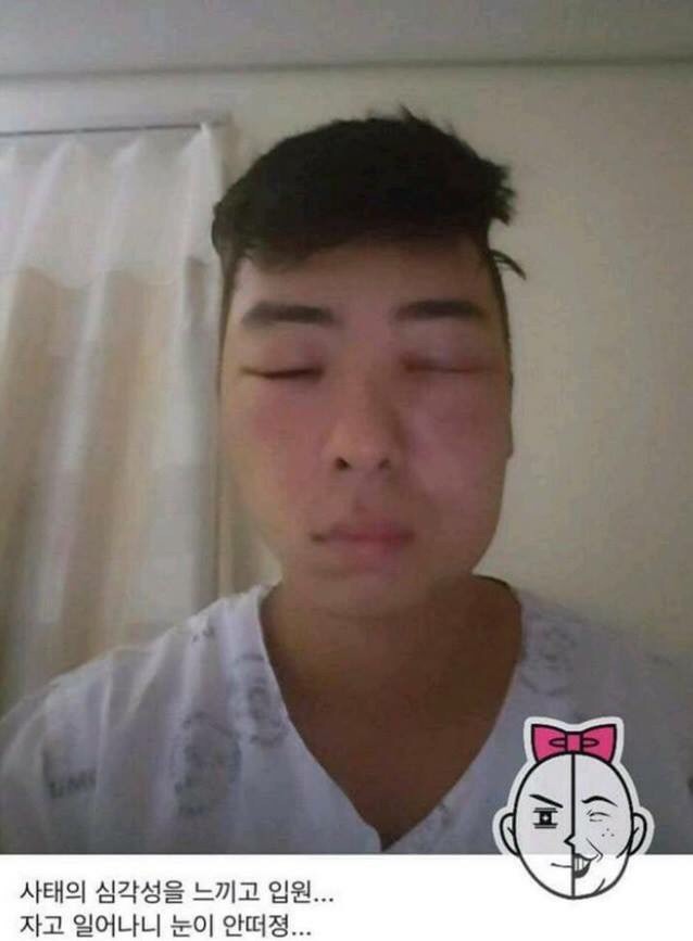 염색약 부작용 ㅎㄷㄷ(혐오주의) | 인스티즈