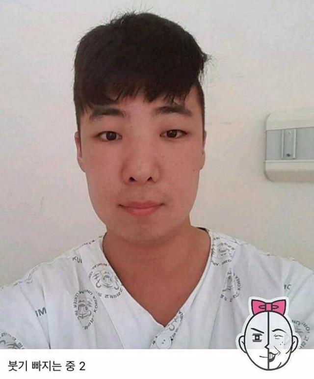 염색약 부작용 ㅎㄷㄷ(혐오주의) | 인스티즈