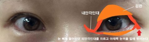 눈꼬리내리기뒤트임하고 인생 제대로 망할 뻔 했습니다.*혐오주의 | 인스티즈