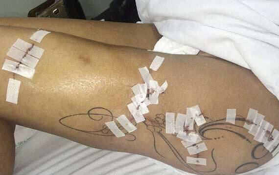 브라질 엉덩이 성형 부작용 (시룸 주의) | 인스티즈