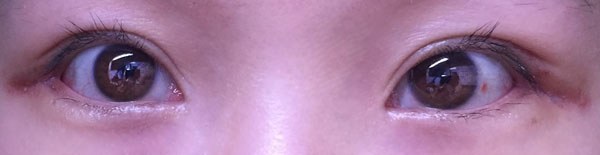 눈꼬리내리기뒤트임하고 인생 제대로 망할 뻔 했습니다.*혐오주의 | 인스티즈