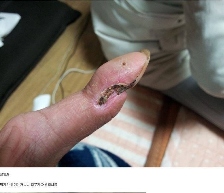 독사에물리면! [[]] | 인스티즈