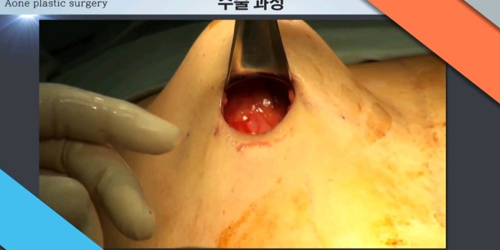 보형물 이용한 가슴성형.jpg (사진주의) | 인스티즈