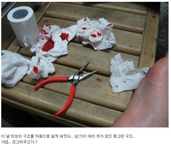 이쯤에서 생각나는 티눈뽑기 (혐오주의) | 인스티즈