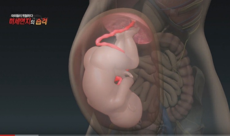미세먼지가 위험한 진짜 이유 | 인스티즈