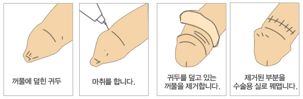 [소름주의] 남성 포경수술 과정 | 인스티즈