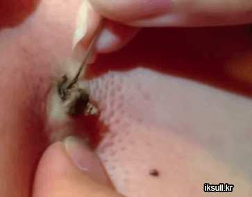 피지 제거.gif (혐오주의) | 인스티즈