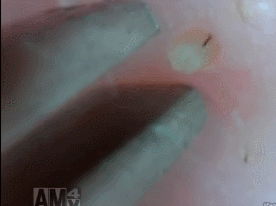 약혐 피지 제거 gif | 인스티즈