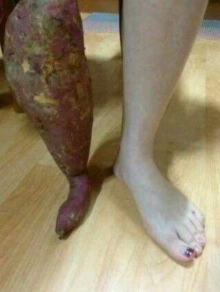 남자친구한테 화상입었다고 구라를 쳐봤다 | 인스티즈