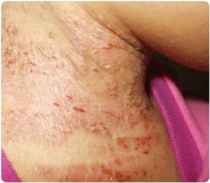 비교적 흔한 사람 미치게 만드는 질환들 | 인스티즈