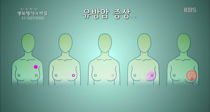 가슴에 멍울은 다 있는거 아님? 유방암이랑 뭐가 달라? | 인스티즈