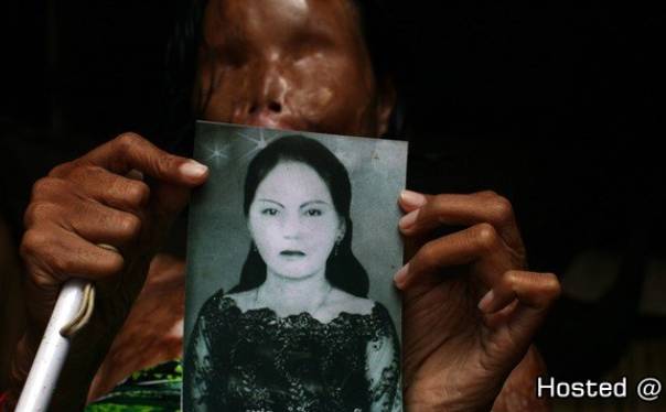 캄보디아 남편에게 산성 공격 당한 여성 (혐오주의) | 인스티즈