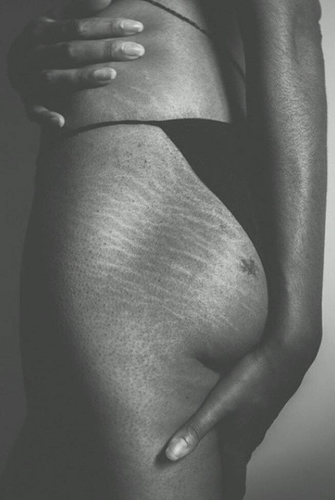 피부 튼살로 고민이 많은 여시들이 봐줬으면 하는 글 | 인스티즈