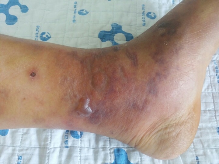 군대에서 행군때문에 가장 많이 걸리는병 | 인스티즈