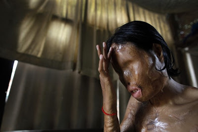 캄보디아 남편에게 산성 공격 당한 여성 (혐오주의) | 인스티즈