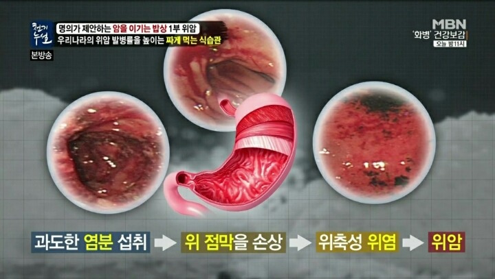 위암 발병률 세계 1위 한국.jpg | 인스티즈