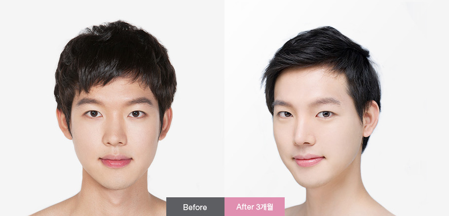 남자성형 전-후 | 인스티즈