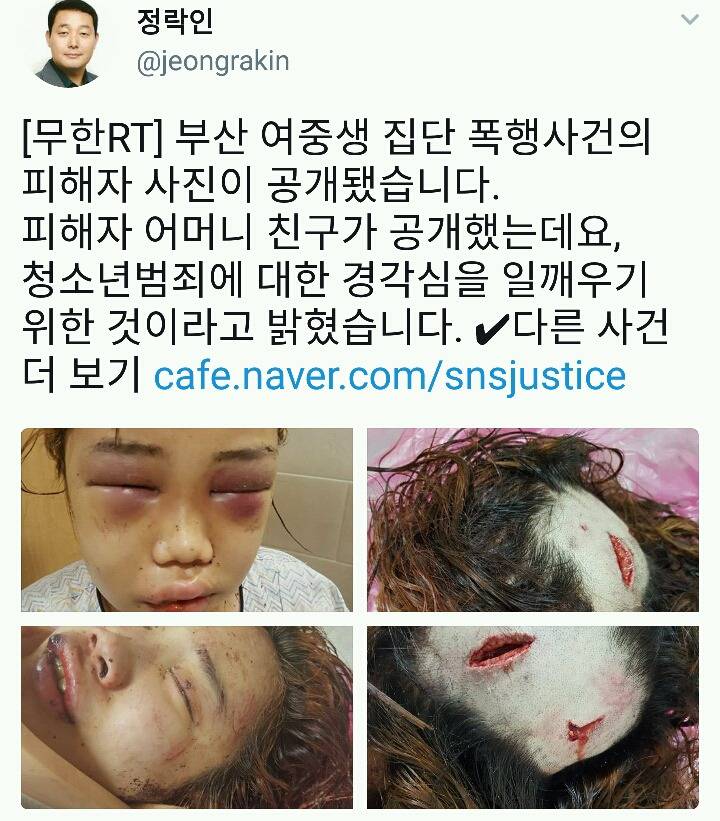 부산 여중생 폭행사건,피해자 학생 상태 심각성 | 인스티즈