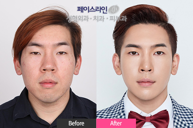 남자도 성형해야하는 EU | 인스티즈