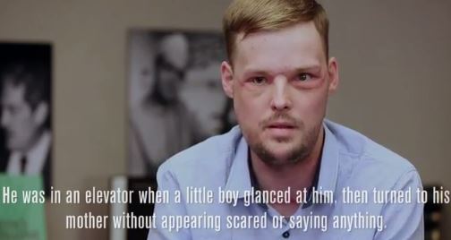 미국 미네소타 마요 클리닉에서 얼굴 이식술 성공 (혐오주의) | 인스티즈