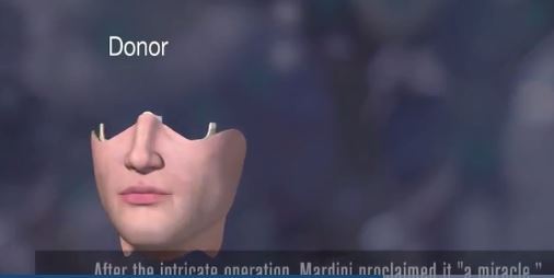 미국 미네소타 마요 클리닉에서 얼굴 이식술 성공 (혐오주의) | 인스티즈