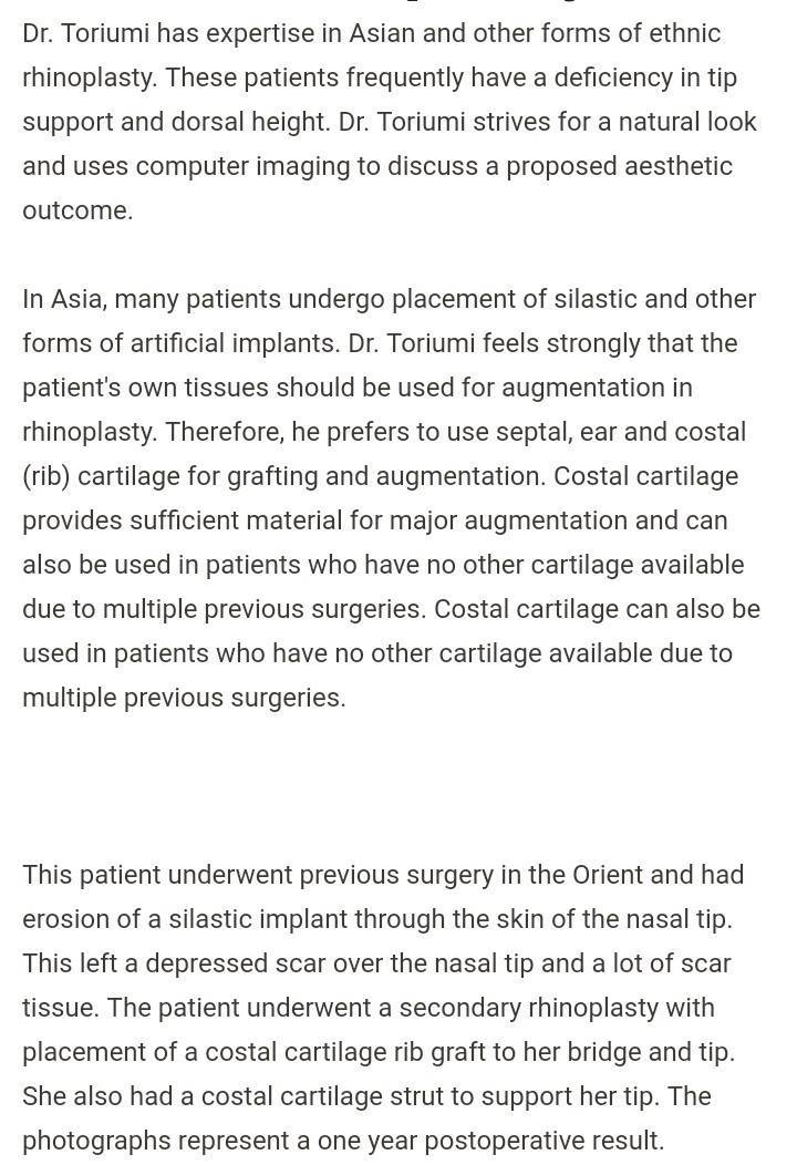 아시안여자코수술 드라마틱하다 | 인스티즈