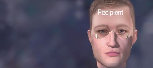 미국 미네소타 마요 클리닉에서 얼굴 이식술 성공 (혐오주의) | 인스티즈