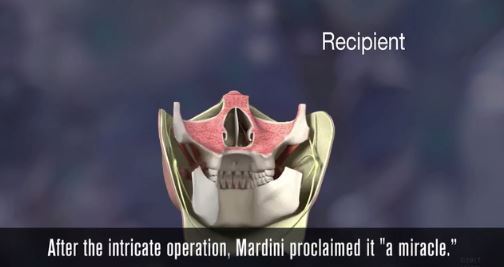 미국 미네소타 마요 클리닉에서 얼굴 이식술 성공 (혐오주의) | 인스티즈