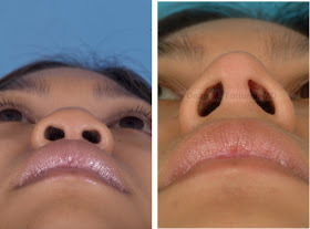 아시안여자코수술 드라마틱하다 | 인스티즈