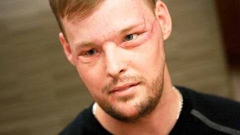 미국 미네소타 마요 클리닉에서 얼굴 이식술 성공 (혐오주의) | 인스티즈