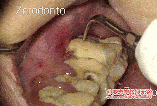 치석 제거.gif (혐오주의) | 인스티즈