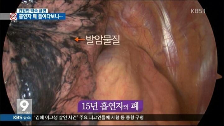 혐오주의) 흡연자의 폐 | 인스티즈